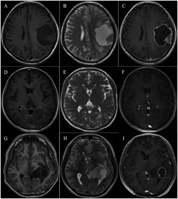 Spotlights on adult patients with pediatric-type diffuse gliomas in accordance with the 2021 WHO classification of CNS tumors